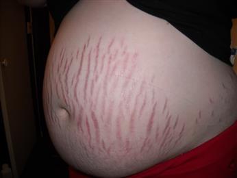 Stretch marks