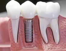 Free Dental Services For Qualified Patients